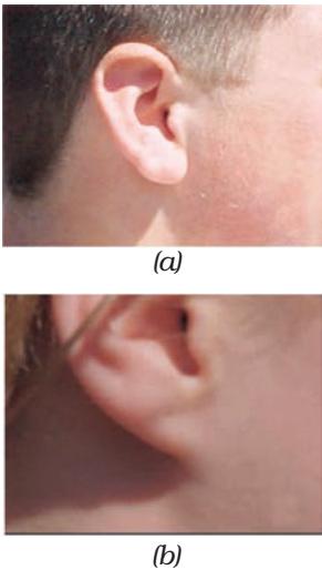Figure 8.2 (a) Free and (b) attached earlobes. The lowest part of the ear, called the earlobe, is closely attached to the side of the head in some of us, and not in others. Free and attached earlobes are two variants found in human populations.