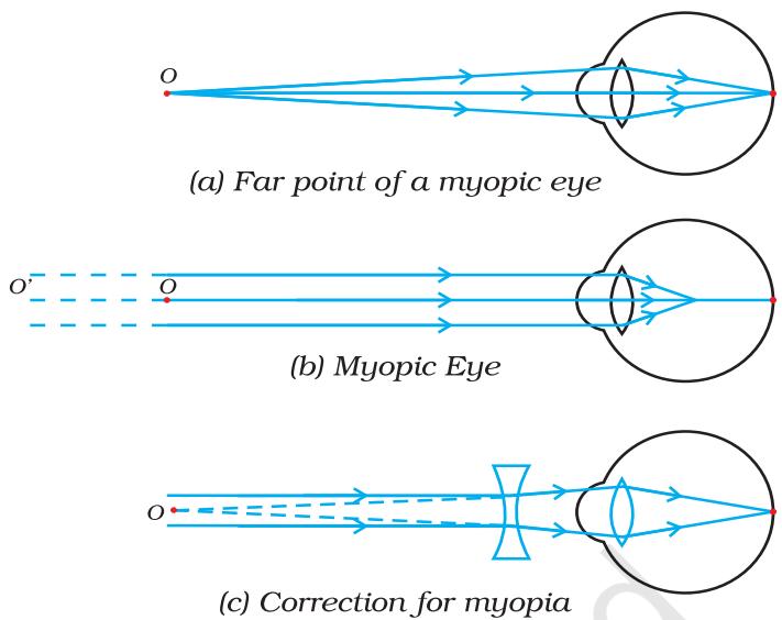 Figure 10.2 (a), (b) The myopic eye, and (c) correction for myopia with a concave lens