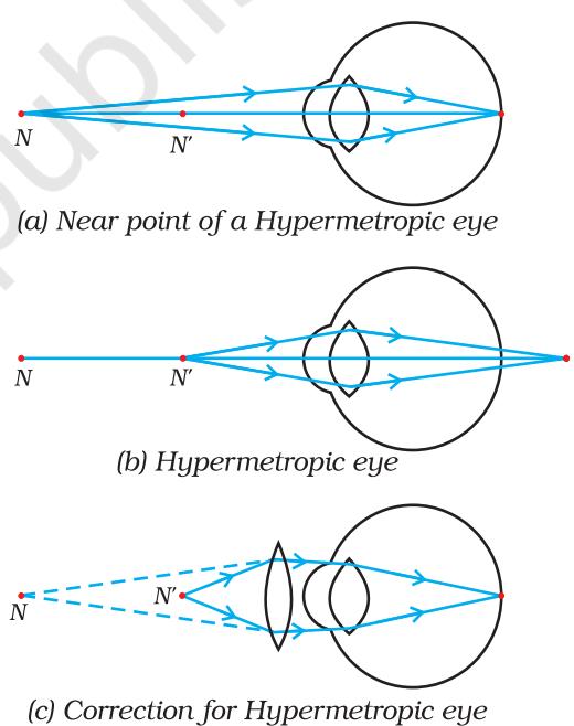 Figure 10.3 (a), (b) The hypermetropic eye, and (c) correction for hypermetropia